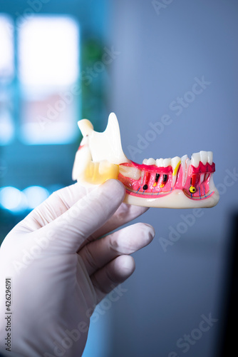 Tooth decay dental model