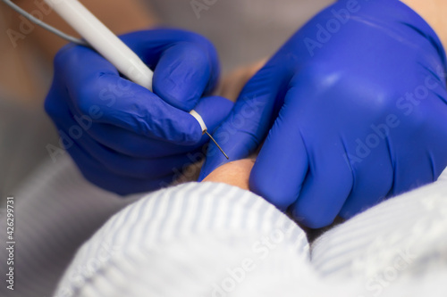 The doctor's hands in sterile medical gloves of blue color make the procedure of removing papillomas with a special tool.