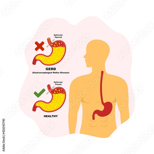 Gastroesophageal reflux disease (GERD), illustration of the health condition of the human stomach.