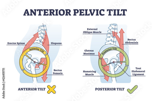 Anterior pelvic tilt model compared with posterior in labeled outline diagram photo
