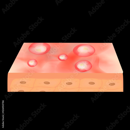 Cyst acne. furuncle Acne on the skin cysts and pimples. Dermatological and cosmetic inflammatory diseases on the skin of the face. Infographics. Vector illustration on isolated background.