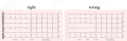 ECG example of a normal 12-lead sinus rhythm, comparison of correct and incorrect electrode positioning photo