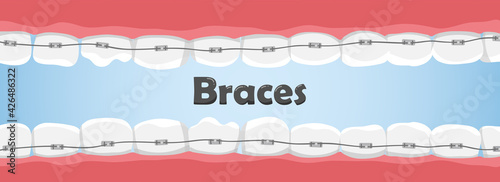 Human teeth with braces in the mouth. Crooked teeth. dental care concept.