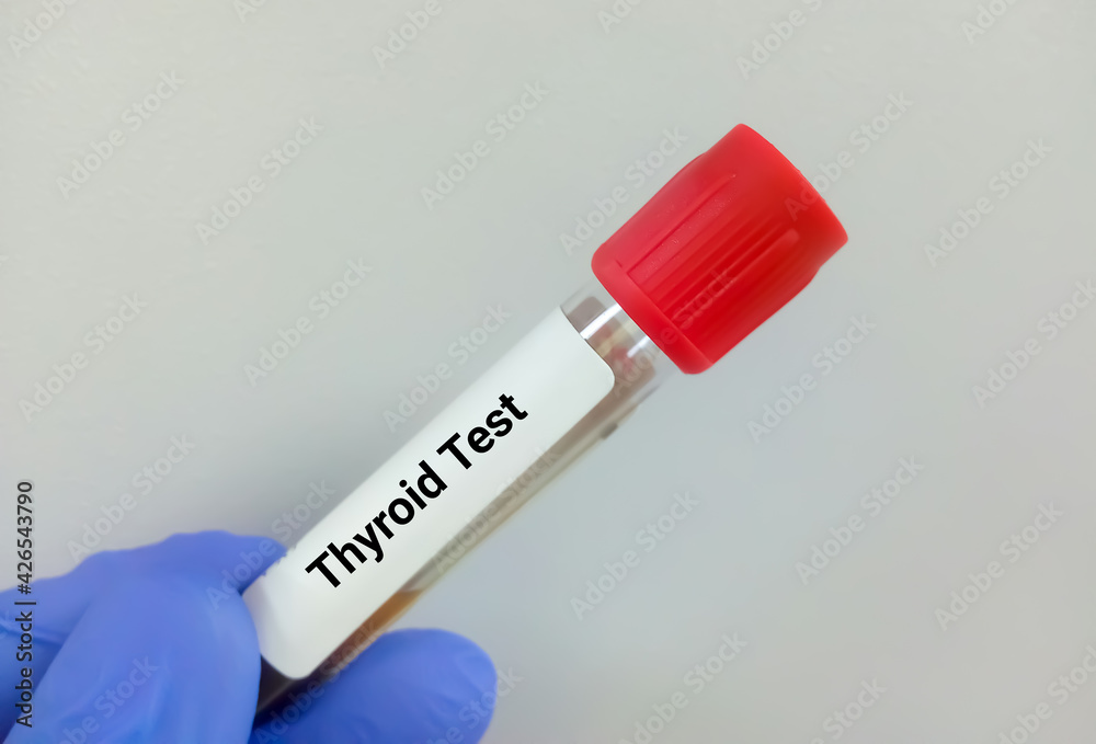 Blood sample in test tubes for hormonal examination of thyroid gland in laboratory. Total T3