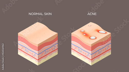 acne vulgaris or pimple and normal skin cross-section of human skin layers structure skincare medical concept flat horizontal