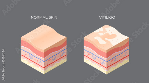 vitiligo and normal skin cross-section of human skin layers structure skincare medical concept flat horizontal