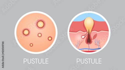 skin pastule pimples acne type face pore comedones cosmetology skincare problems concept flat horizontal