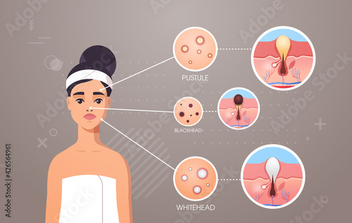 different types of facial skin acne pustule blackhead whitehead pimples on woman face pore comedones cosmetology skincare problems concept flat portrait horizontal