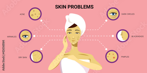 facial skin pimples acne different types on woman face pore comedones cosmetology skincare problems concept flat portrait horizontal