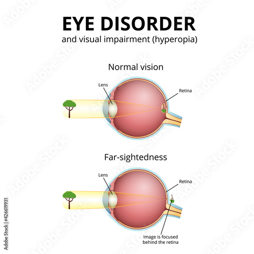 structure of the eyeball, visual impairment, farsightedness