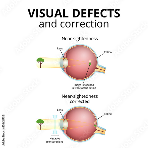 structure of the eyeball, visual impairment, near-sightedness