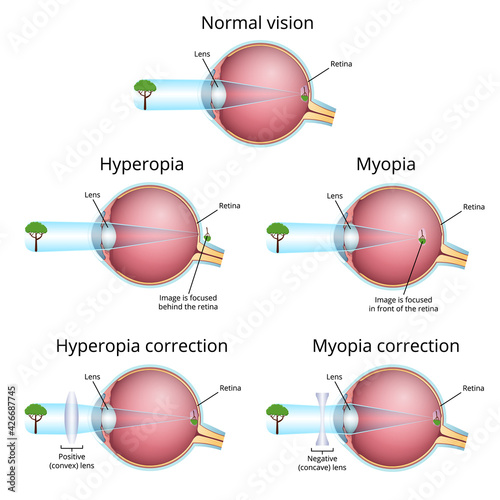 vision problems and their correction, myopia and hyperopia
