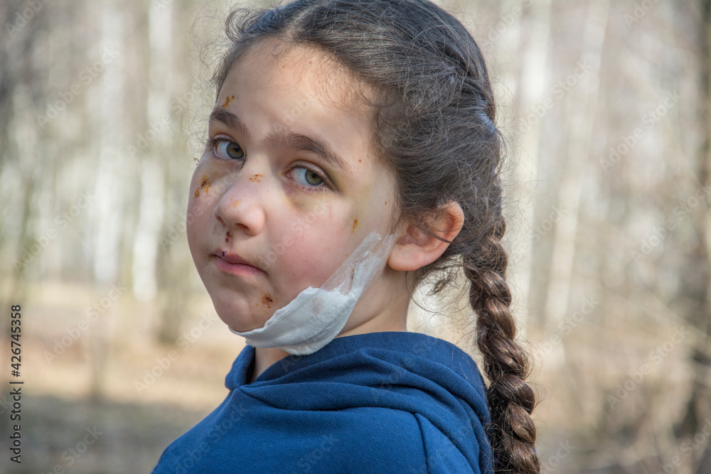 In the spring, in the forest, the girl's face is covered with scratches and bruises after a dog bite. In the spring, in the forest, the girl's face is covered with scratches and bruises after a dog bite.