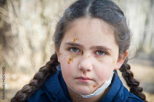 In the spring, in the forest, the girl's face is covered with scratches and bruises after a dog bite.