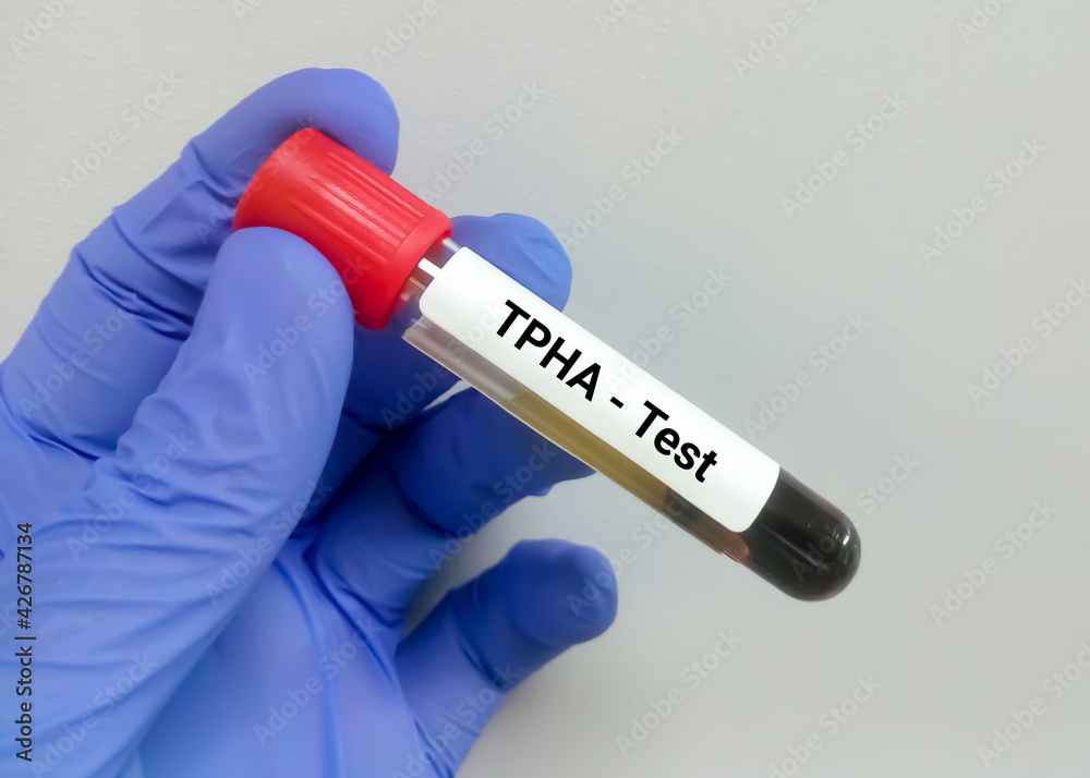 Blood sample for Treponema pallidum haemagglutination (TPHA) test, Syphilis disease diagnosis
