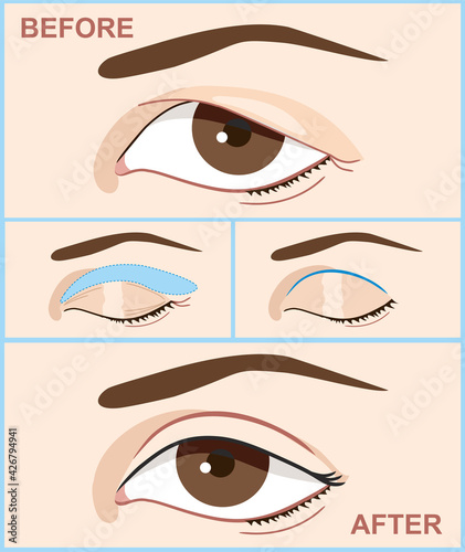 Blepharoplasty of eyelid. Before and after the double eyelid surgery of women. Vector illustration with double eyelid surgery. Infographics with icons of plastic surgery procedures.
