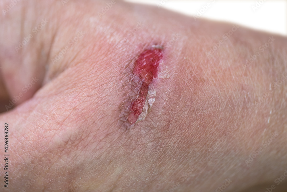 Fototapeta premium Abrasion with some fluid discharge from a woman's hand.