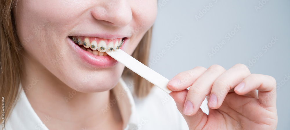 Young woman with metal braces on her teeth is chewing gum. The girl is eating gummy candy Young woman with metal braces on her teeth is chewing gum. The girl is eating gummy candy
