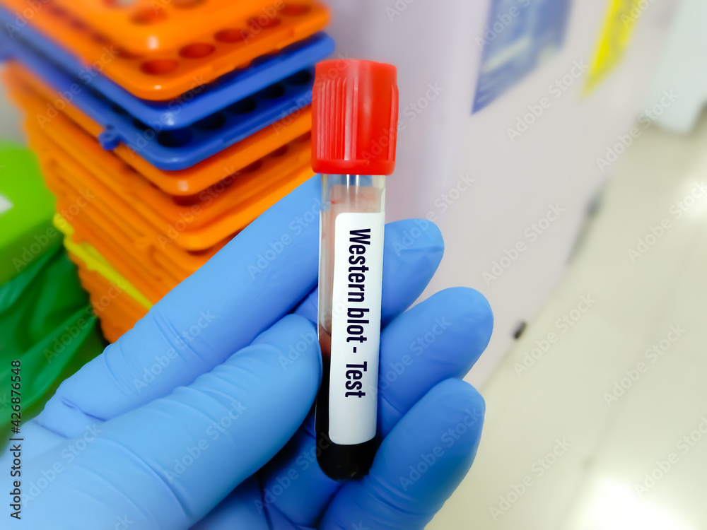 Blood sample tube for Western blot test, confirmatory test for HIV