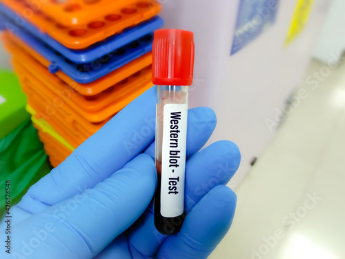 Blood sample tube for Western blot test, confirmatory test for HIV infection photo