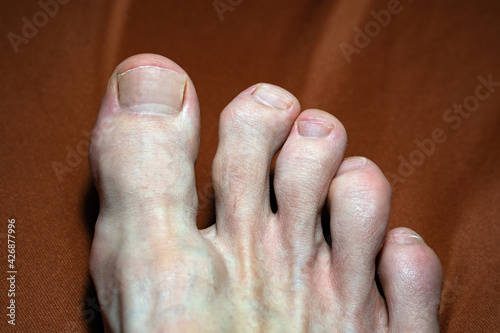 close-up of gouty toes. toes affected by Gout - a disease in which defective metabolism of uric acid causes arthritis, especially in the smaller bones of the feet. photo