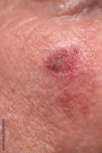Detail of red crusty lesions of actinic keratosis or sunspots on sun-damaged skin on the cheek under the right eye of a man. This can be treated with cryosurgery or certain ointments