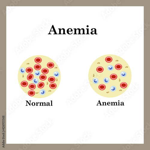 Anemia. The reduced amount of red blood cells. Infographics. Vector illustration