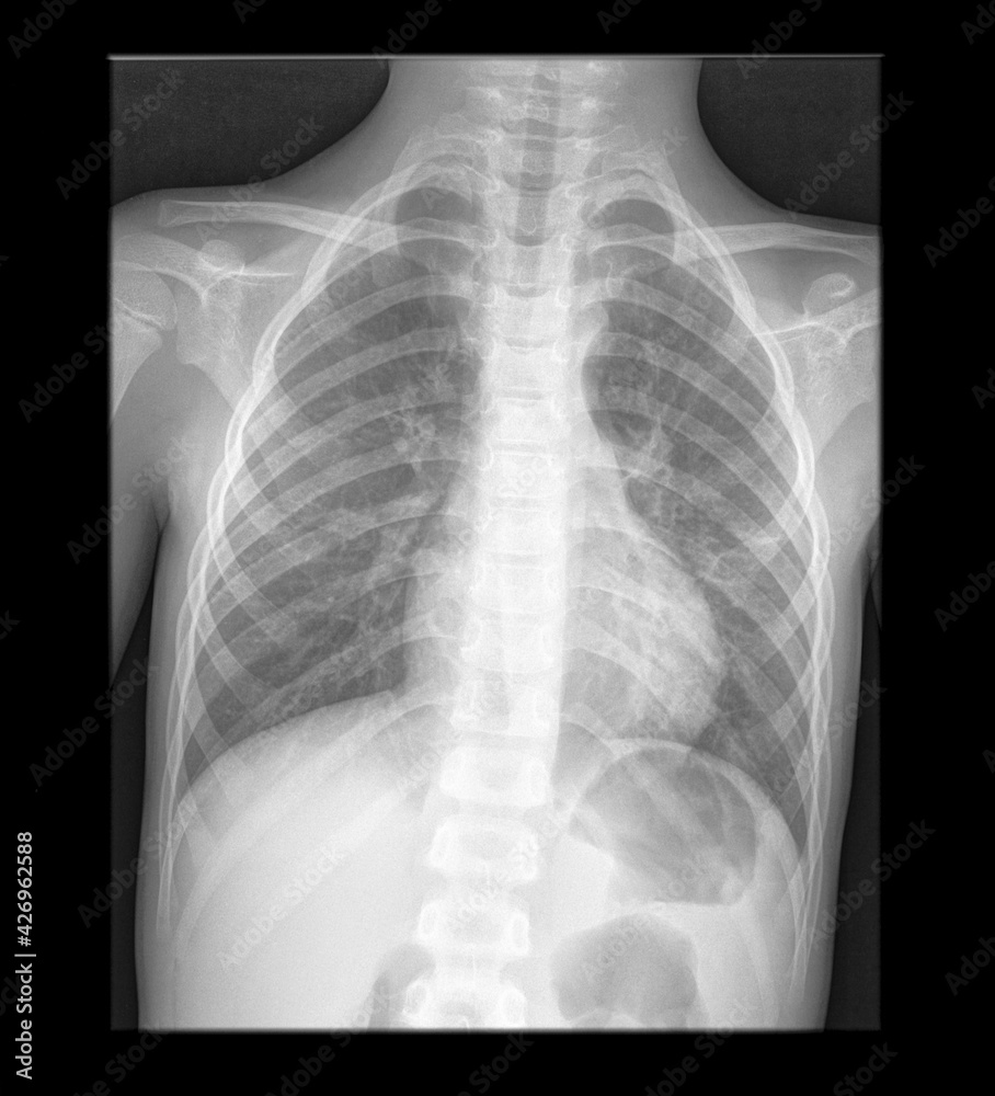 Lung woman x-ray film. Chest radiology scan. Health care patient examination. Lung woman x-ray film. Chest radiology scan. Health care patient examination.