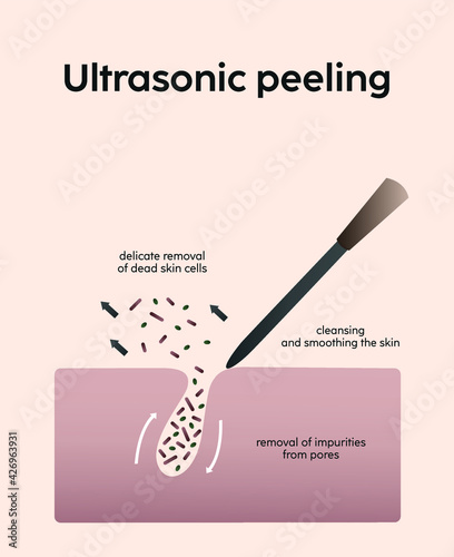 Ultrasonic peeling cleansing smoothing skin care removing dead cells cosmetology scheme infographics banner information poster for students and patients