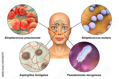 Anatomy of rhinosinusitis and microorganisms that cause sinusitis photo