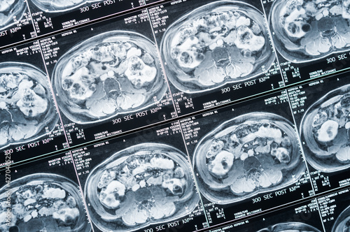 Bild einer Magnetresonaztomographie, MRT,  Computertomographie, Röntgenbild.
Bauchbereich im Querschnitt
Bereich des Becken mit Nieren, die von Tumoren befallen sind. photo