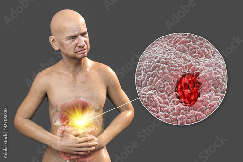 A patient suffering from stomach ulcer with highlighted inner organs of digestive system and close-up view of peptic ulcer photo