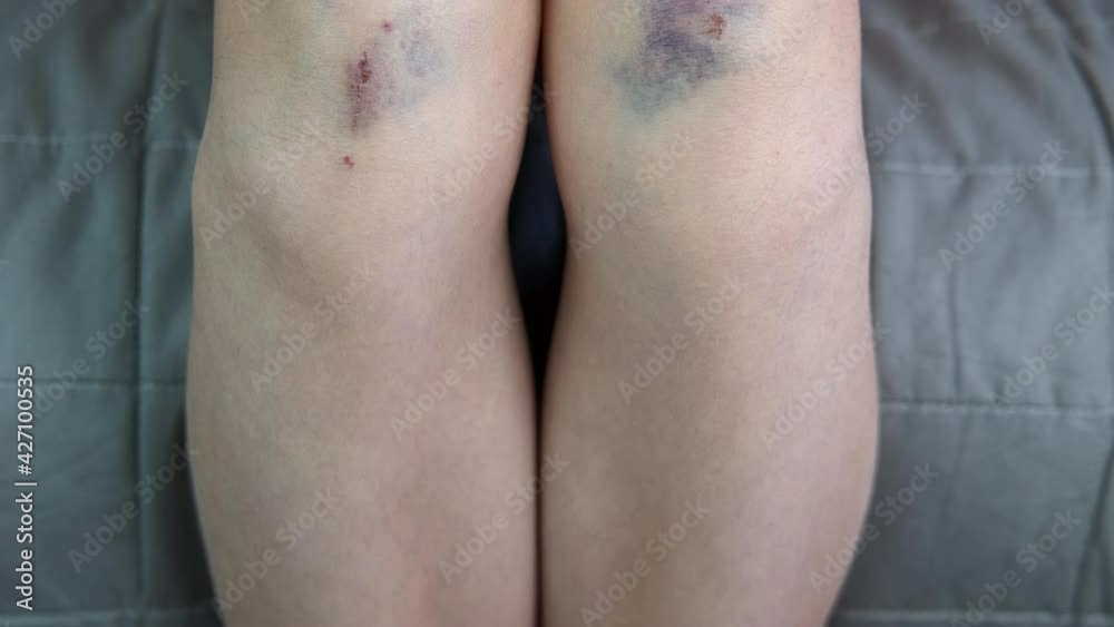 Family child violence. The child's legs are bruised and abraded. Child abuse. Family child violence. The child's legs are bruised and abraded. Child abuse.