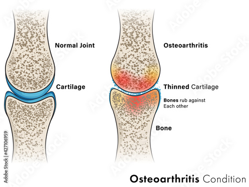 Illustration of Osteoarthritis of Bone.