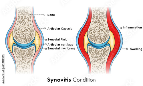 Synovitis condition.  photo