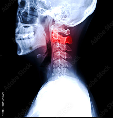 X-ray C-spine or x-ray image of Cervical spine lateral view for diagnostic intervertebral disc herniation and Spondylosis.. photo