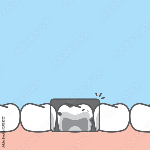 Blank banner lower x-ray unhealthy unhygienic decay teeth illustration vector design on blue background. Dental care concept.