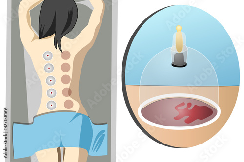 Vector illustration of traditional cupping therapy