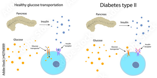 Diabetes type 2 and healthy transportation comparison. Pancreas, insulin receptor, glucose transporter, cell.