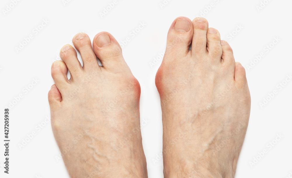 Varus valgus and Hallux valgus, bunion on white background Varus valgus and Hallux valgus, bunion on white background