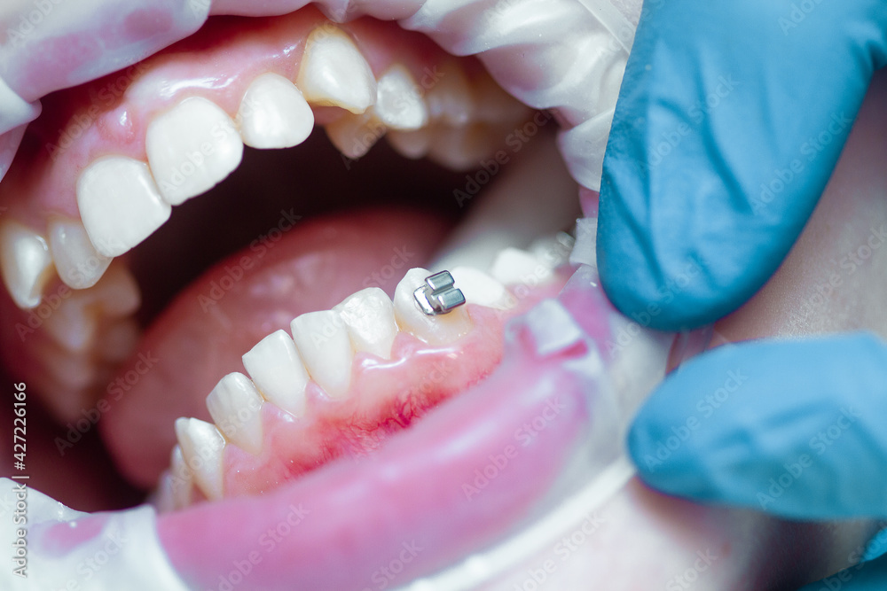 Baby Pulling Teeth For Braces