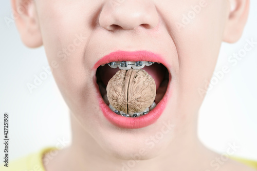 The girl holds in the teeth with braces walnut. Concept of dentistry and installation of braces.