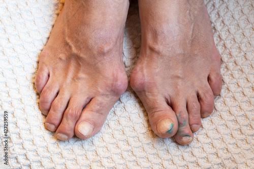 Painful gout inflammation on toe joints. Inflammation and deformity of the toes photo