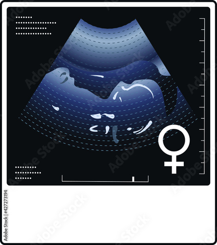 Ultrasound photo of a fetus with a gender female symbol.