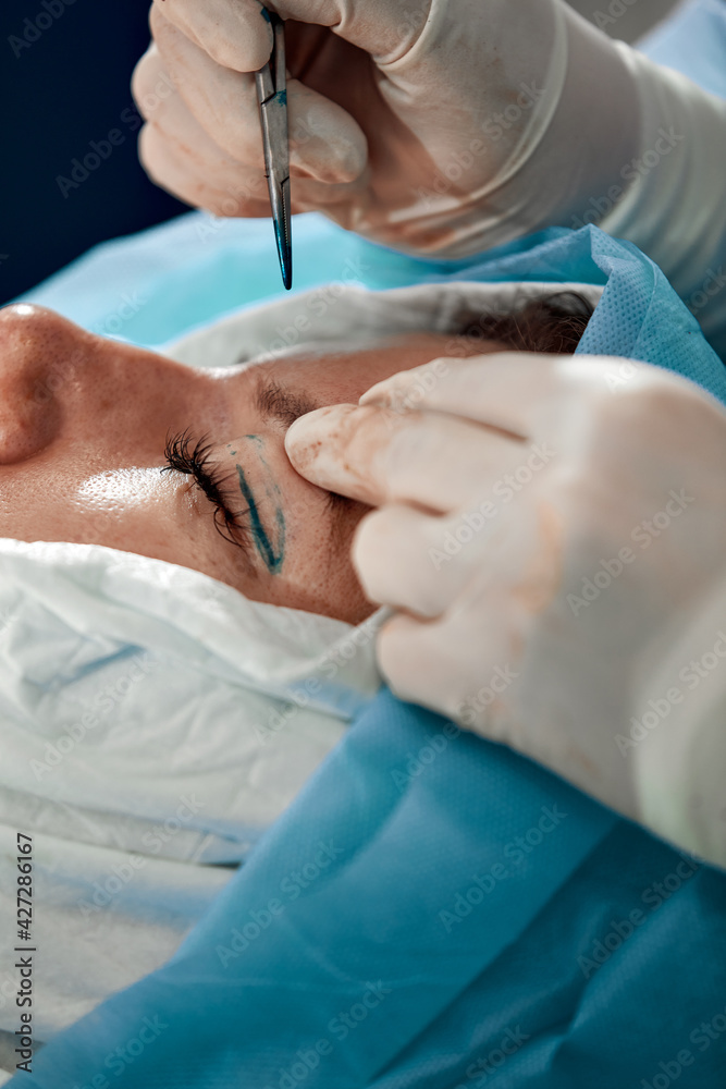 Close up of the face of a patient undergoing blepharoplasty. The surgeon cuts the eyelid and performs manipulations using medical instruments Close up of the face of a patient undergoing blepharoplasty. The surgeon cuts the eyelid and performs manipulations using medical instruments
