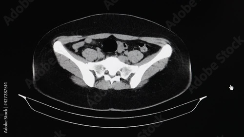 A motion CT can of an abdomen of a female patient with ovarian cysts.