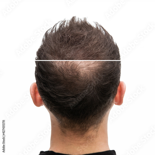 Vorher Nachher - Halbglatze eines Mannes mit Haarausfall	von hinten photo