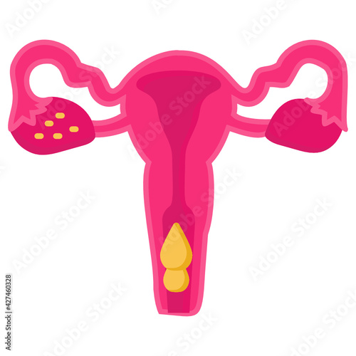 Abnormal Uterine Bleeding Concept, Extremely heavy period Vector Icon Design, In Vitro Fertilization Symbol, Pregnancy and obstetrician Sign, test tube baby procedure stock illustration