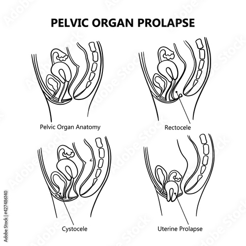 PELVIC ORGAN PROLAPSE VARIOUSLY MONOCHROME Of Women General Diagram With Explanatory Text For Medical Education Clip Art Vector Illustration Set For Print