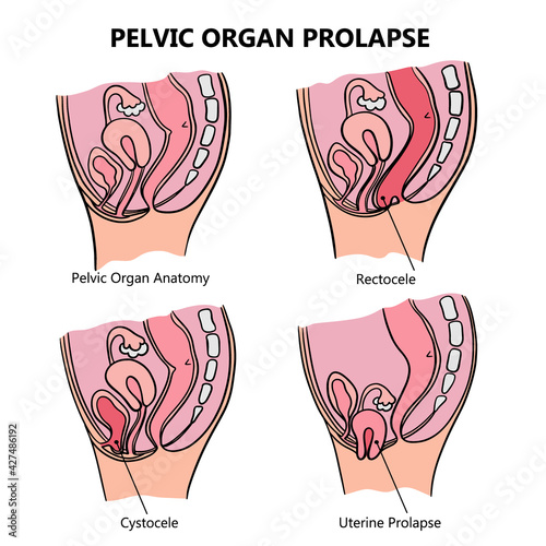 PELVIC ORGAN PROLAPSE VARIOUSLY Of Women General Diagram With Explanatory Text For Medical Education Clip Art Vector Illustration Set For Print